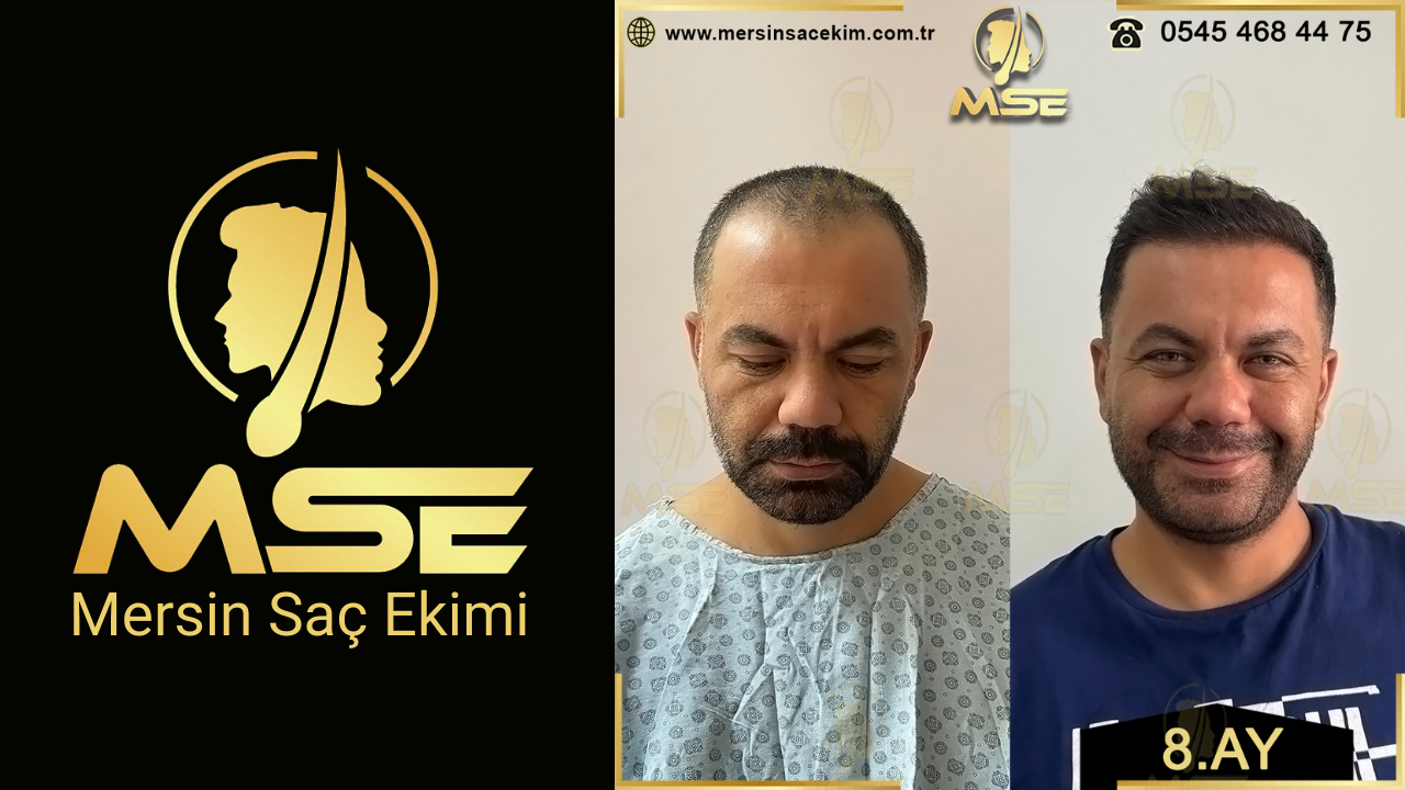 Mersin Saç Ekimi